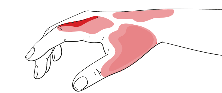 Dłoń z oparzeniem chemicznym