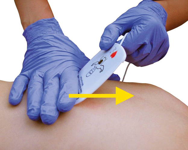 Naklejanie elektrody