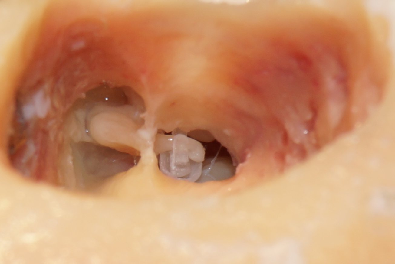 Prototyp komorowej protezki strzemiączka zaimplantowany w uchu środkowym (preparat kości skroniowej post mortem)