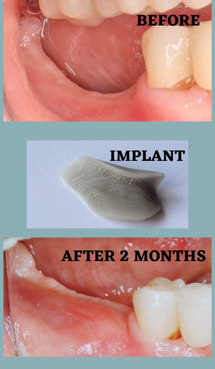 Nasz implant po 2 miesiącach