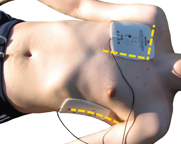 Naklejanie elektrody