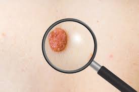  Światowy Miesiąc Świadomości Czerniaka