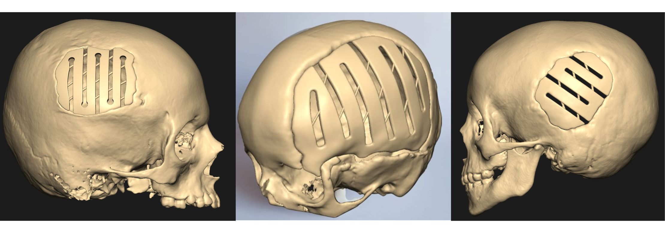 asz patent - adaptacyjny implant czaszki dla najmłodszych pacjentów