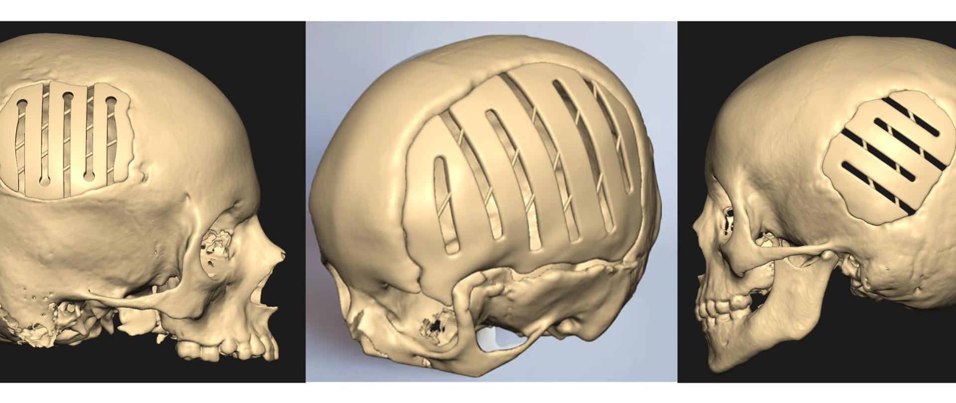 Nasz patent - adaptacyjny implant czaszki dla najm┼éodszych pacjento╠üw