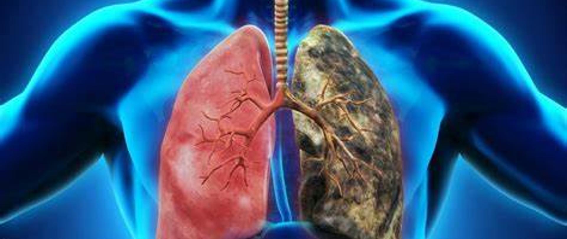 Plakat przedstawiający zdrowe i chore płuco