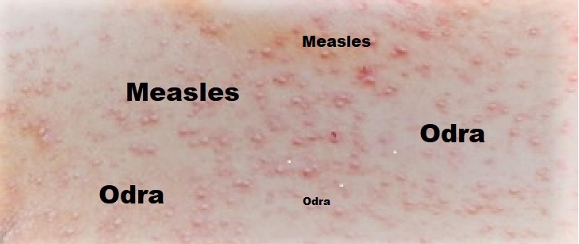 Measles