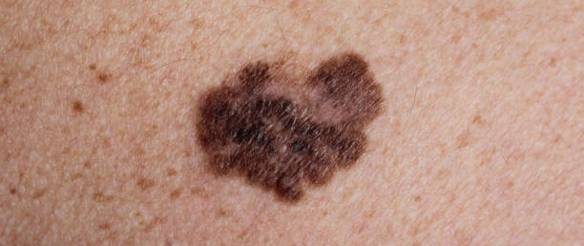 Zdjęcie zmiany skórnej. 