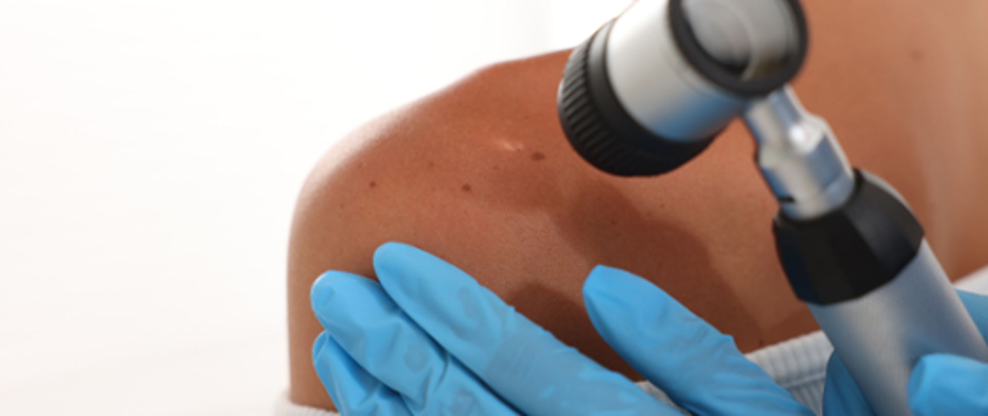 Badanie skóry dermatoskopem podczas kontroli znamion na ramieniu pacjenta