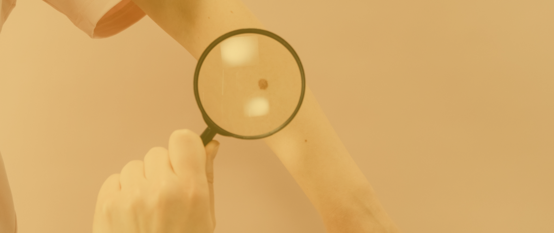 Lupa skierowana na rękę ze znamieniem