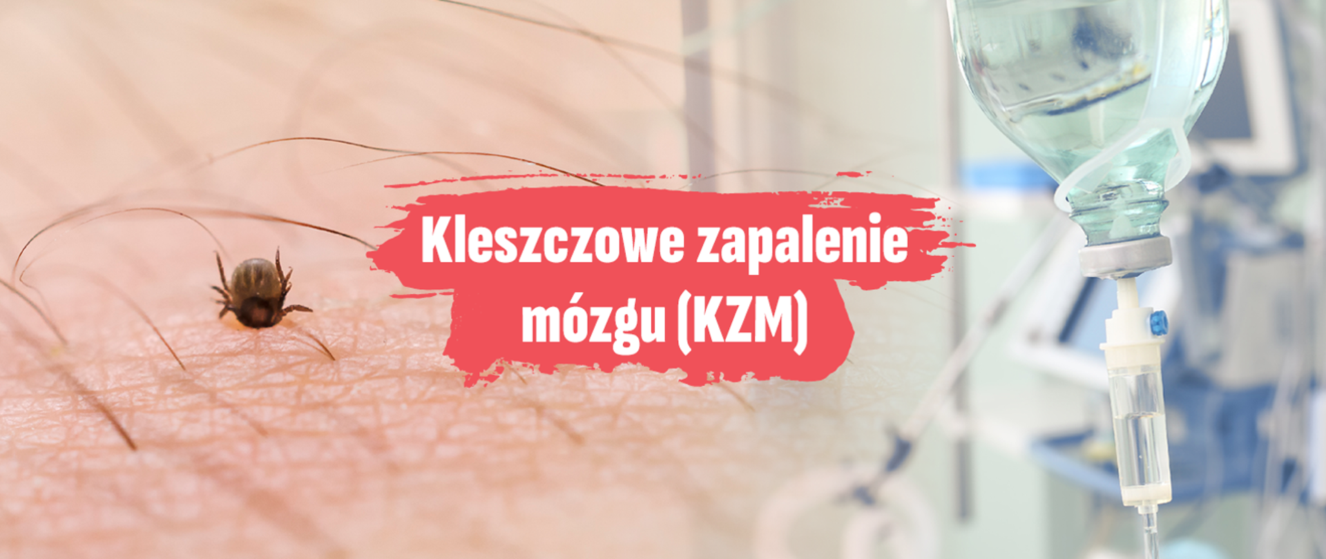 Zbliżenie na kleszcza wbitego w ludzką skórę, z widocznymi włosami wokół miejsca ukłucia. Na środku grafiki znajduje się napis „Kleszczowe zapalenie mózgu (KZM)”, a po prawej stronie widać kroplówkę w szpitalnym otoczeniu. Ilustracja sugeruje zagrożenie zdrowotne związane z ukąszeniem kleszcza i możliwą hospitalizację.