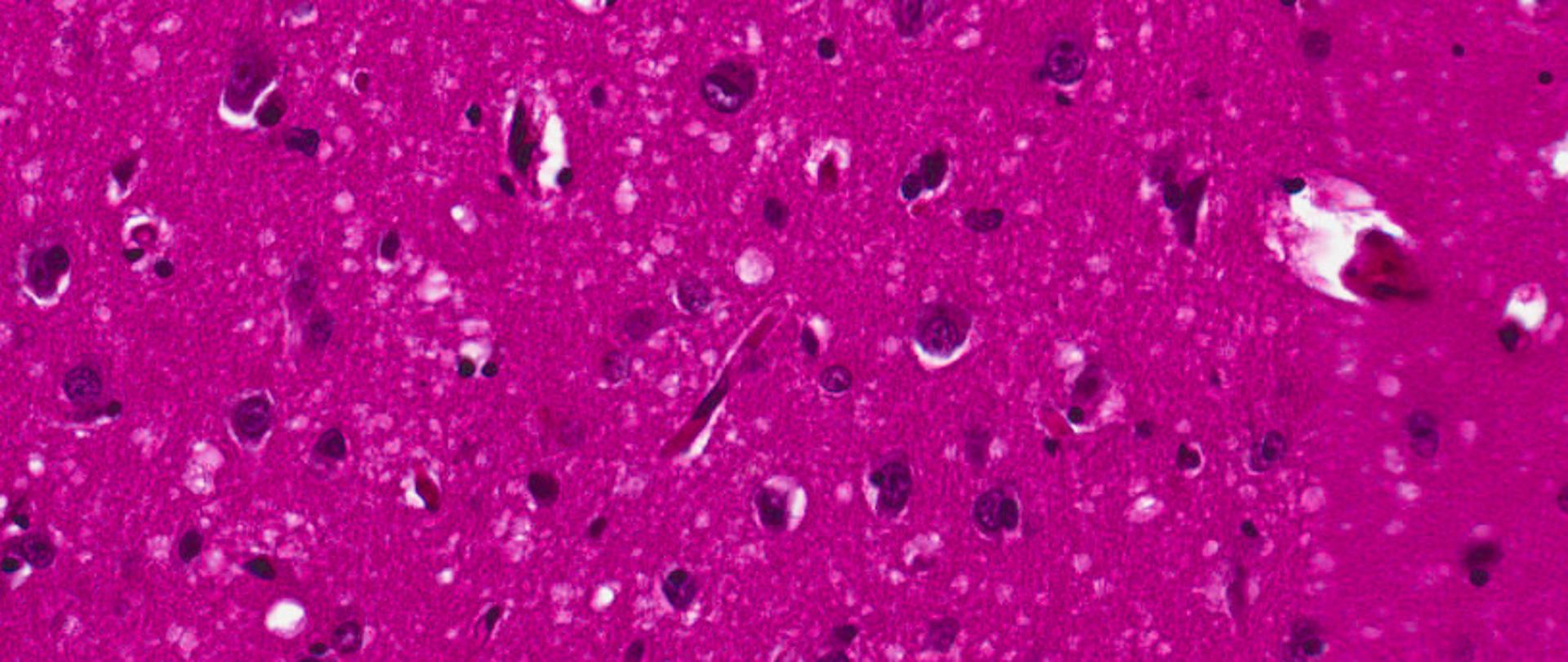 Choroba Creutzfeldta-Jacoba (CJD) jest rzadko występującą, śmiertelną chorobą ośrodkowego układu nerwowego. Zaliczana jest do tzw. pasażowalnych (zakaźnych) encefalopatii gąbczastych. Choroba ta występuje najczęściej pomiędzy 50, a 70 rokiem życia.