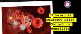 17 kwietnia Światowy Dzień Chorych na Hemofilię