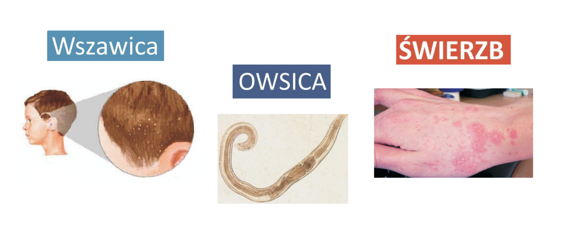 Wszawica, owsica, świerzb. Na grafice ukazano wszy na głowie dziecka, preparat mikroskopowy owsika i świerzb na ręce człowieka.