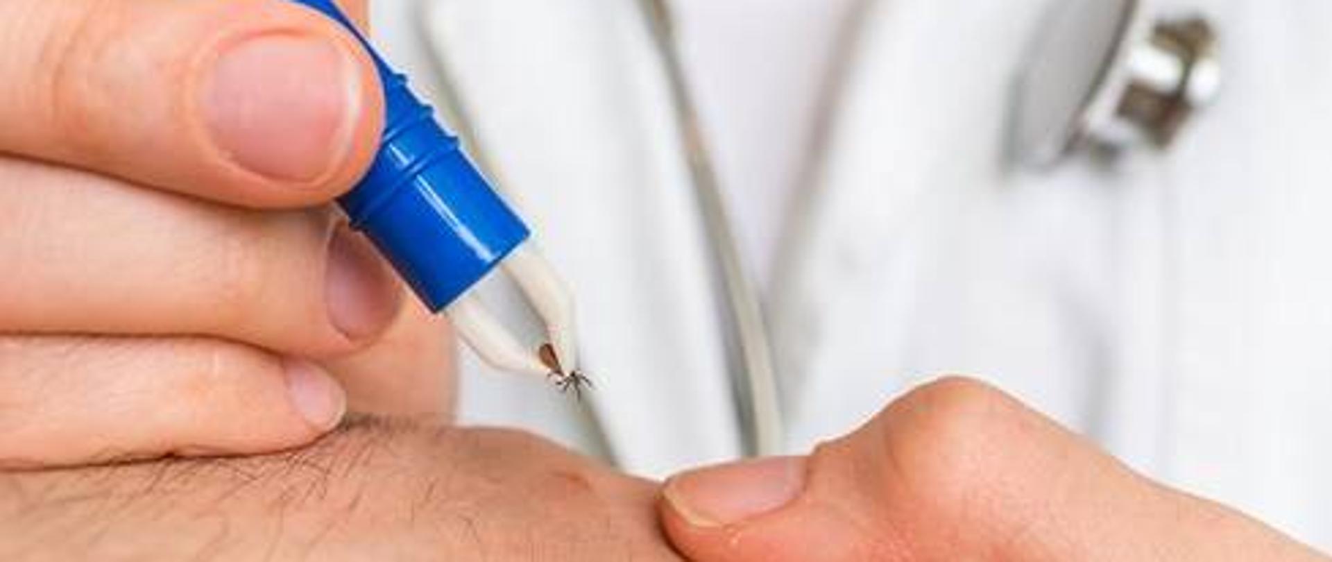 lekarz wyjmujący kleszcza