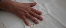 Na zdjęciu ściąganie obrączki ze spuchniętego palca przy użyciu nici