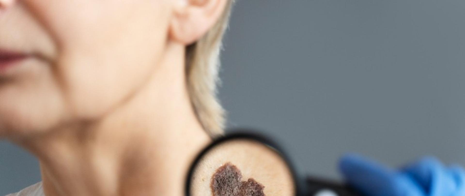 zdjęcie przedstawiające osobę, widoczna jest lewa część twarzy, szyja oraz barki, na szyi widoczna duża brązowa plama o nieregularnych kształtach