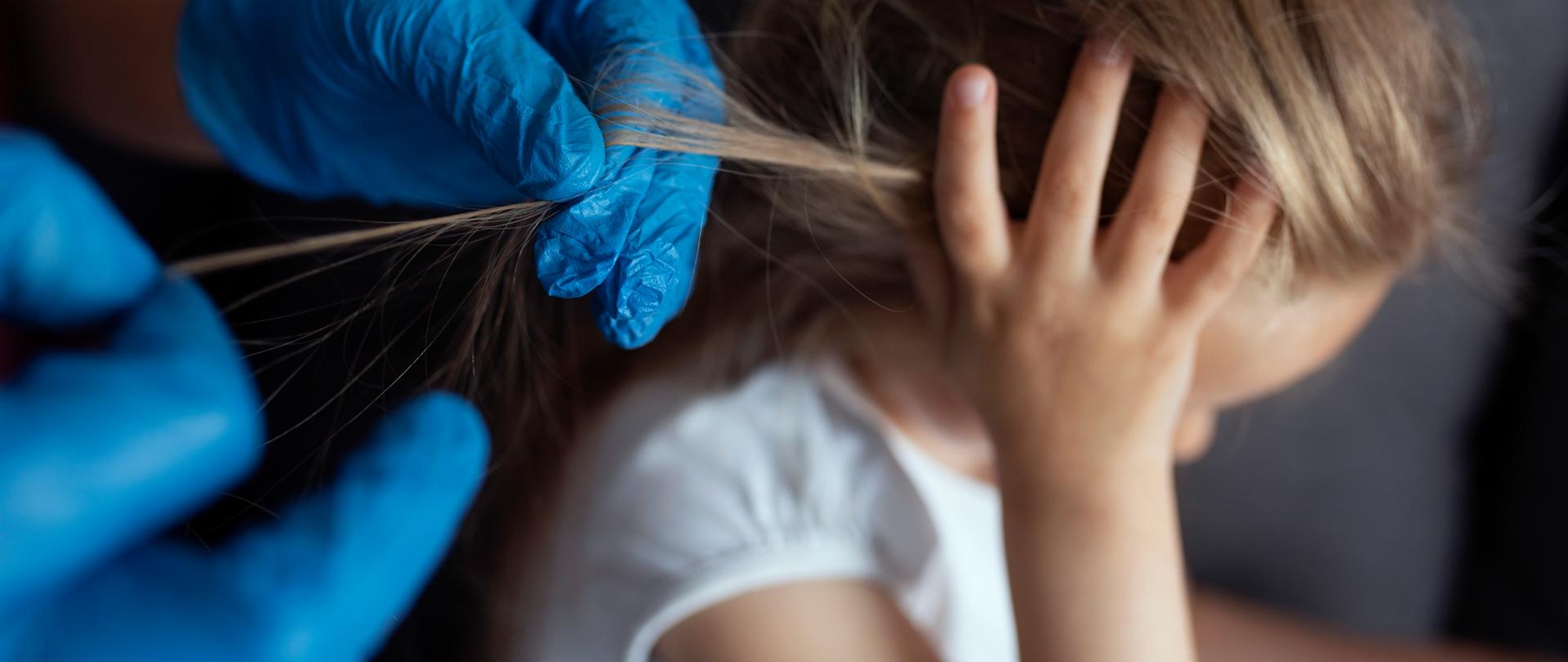 Zdjęcie przedstawiające dziewczynkę z wszawicą