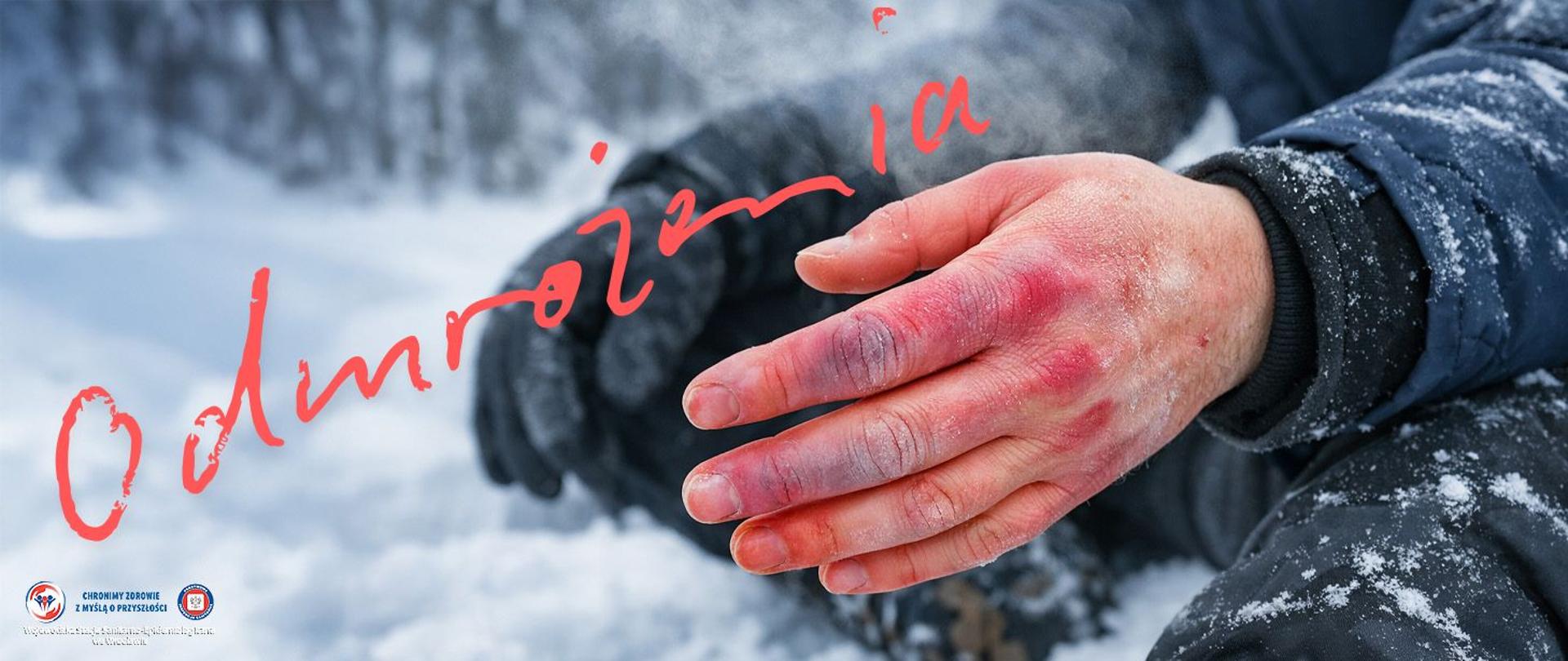 Na zdjęciu widoczna jest dłoń lub stopa osoby narażonej na niską temperaturę – skóra jest zaczerwieniona, miejscami blada lub lekko sinawa, z wyraźnymi oznakami odmrożenia. Fragment ciała może być częściowo odkryty, reszta ubrana w zimową odzież (kurtka, rękawice, buty zimowe), co podkreśla warunki atmosferyczne. W tle zimowy krajobraz: śnieg, mróz, para unosząca się z oddechu lub zamglone, chłodne światło.