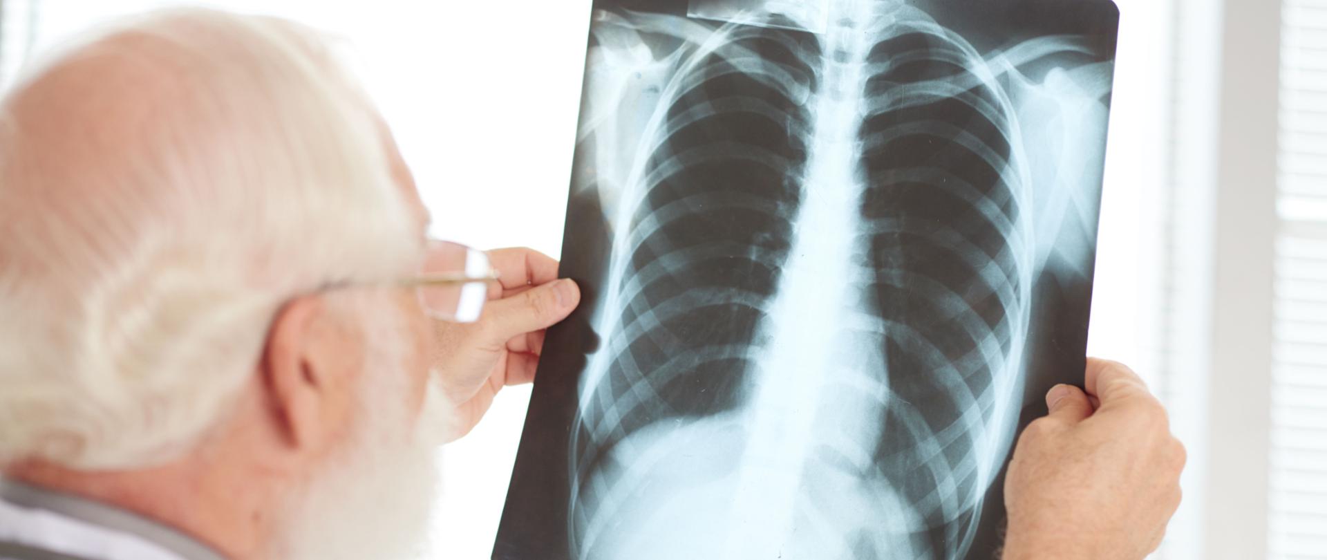 lekarz oglądający prześwietlenie klatki piersiowej