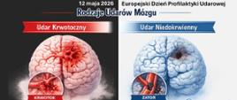12 maja Europejski Dzień Profilaktyki Udarowej - grafika przedstawiająca obrazowo udar krwotoczny i udar niedokrwienny