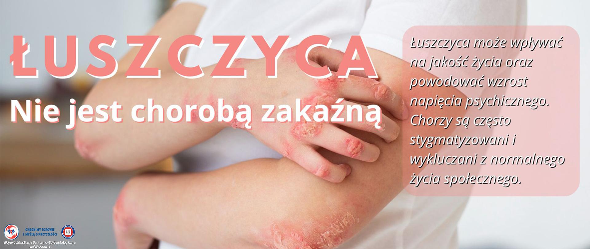 Osoba chora na łuszczyc ę z widocznymi zmianami na skórze przedramion