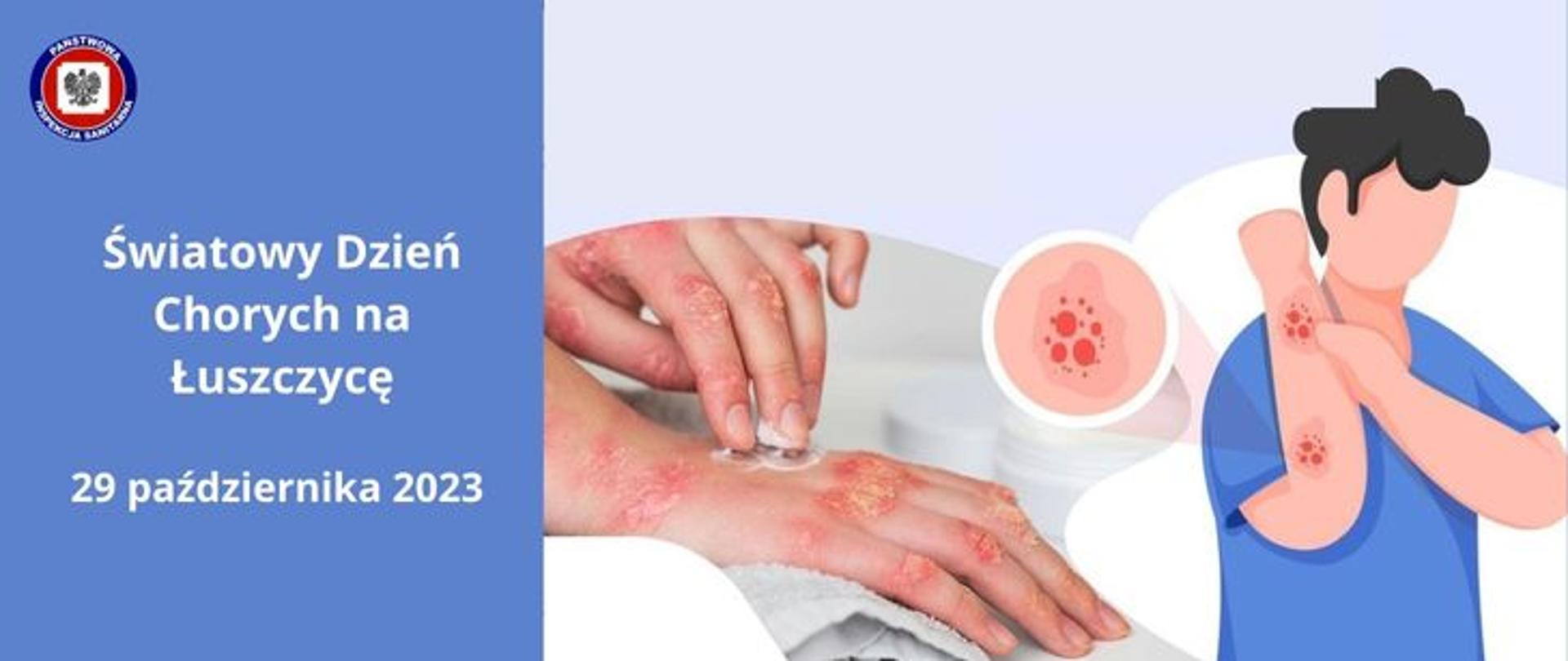 Grafika w jasno niebieskiej kolorystyce, po lewej stronie na niebieskim tle jasny napis Światowy Dzień Chorych na Łuszczycę 29 października 2023, z prawej strony sylwetka mężczyzny o ciemnych kręconych włosach w niebieskiej koszulce drapiąca się po lewej ręce z widocznymi zmianami łuszczycowymi, z jego lewej strony dłonie ze zmianami łuszczycowymi, lewa smaruje kremem prawą dłoń spoczywającą na jasnym ręczniku. 