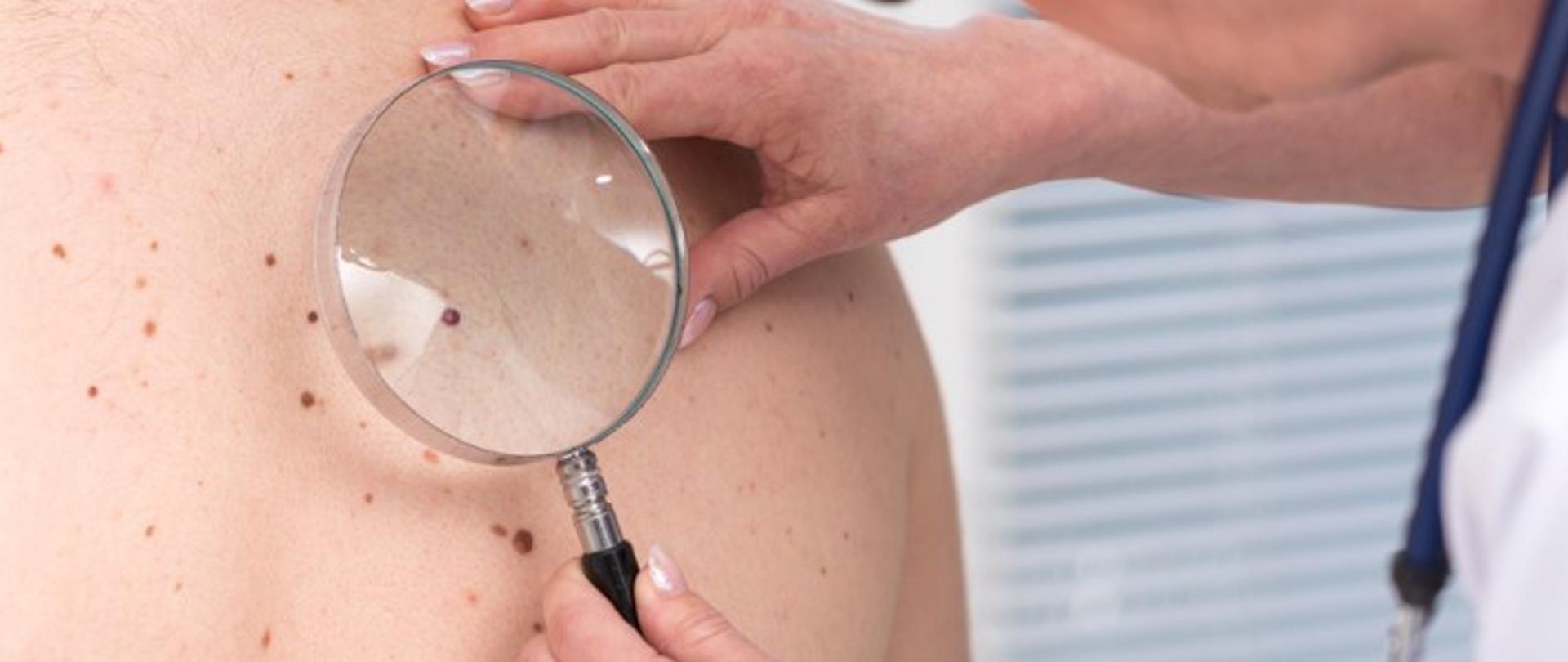 Na zdjęciu widnieje fragment pleców, na których znajdują się liczne pieprzyki/ znamiona. Obok znajdują się dłonie lekarza, w jednej z nich trzyma lupę, przez którą ogląda znamię. 