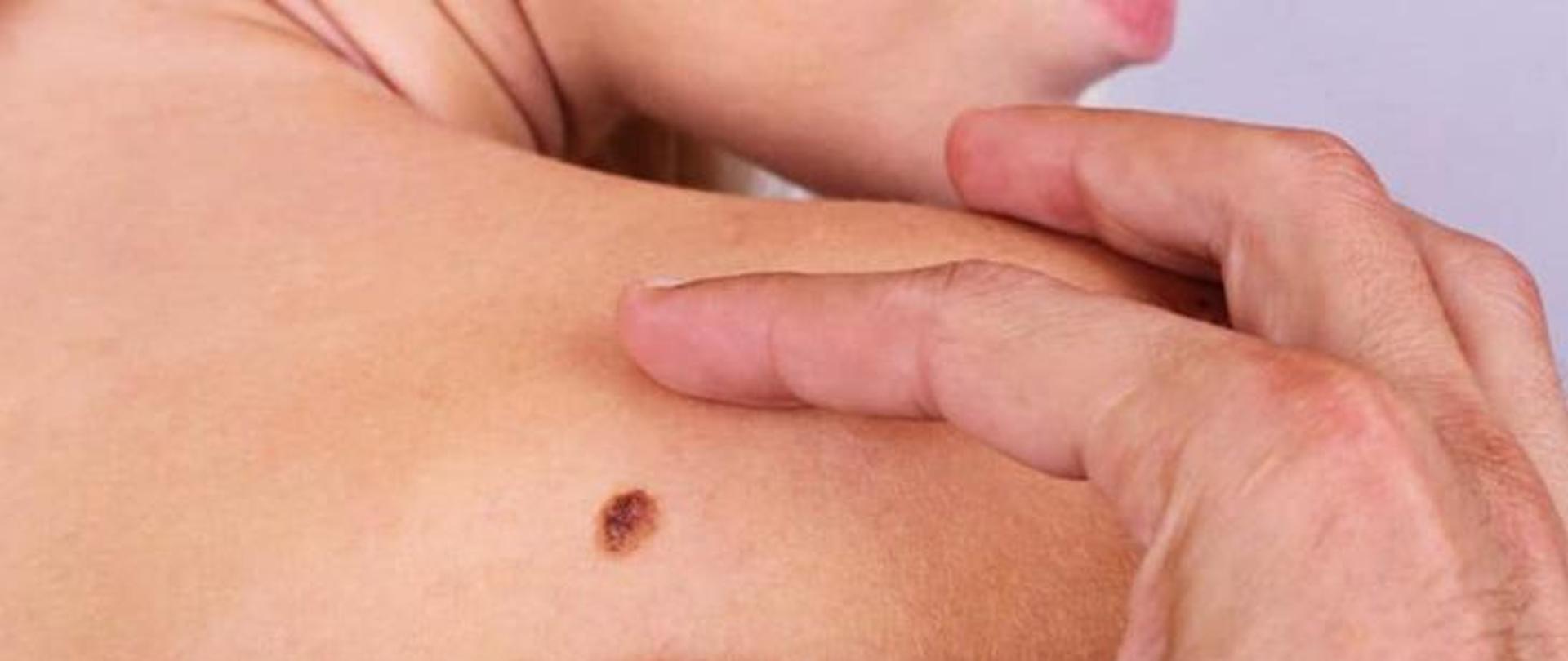 XI Tydzień Świadomości Czerniaka