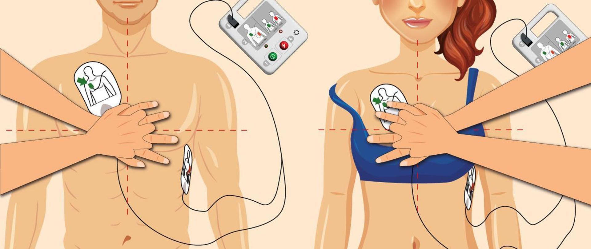 AED - sprzęt, który ratuje życie