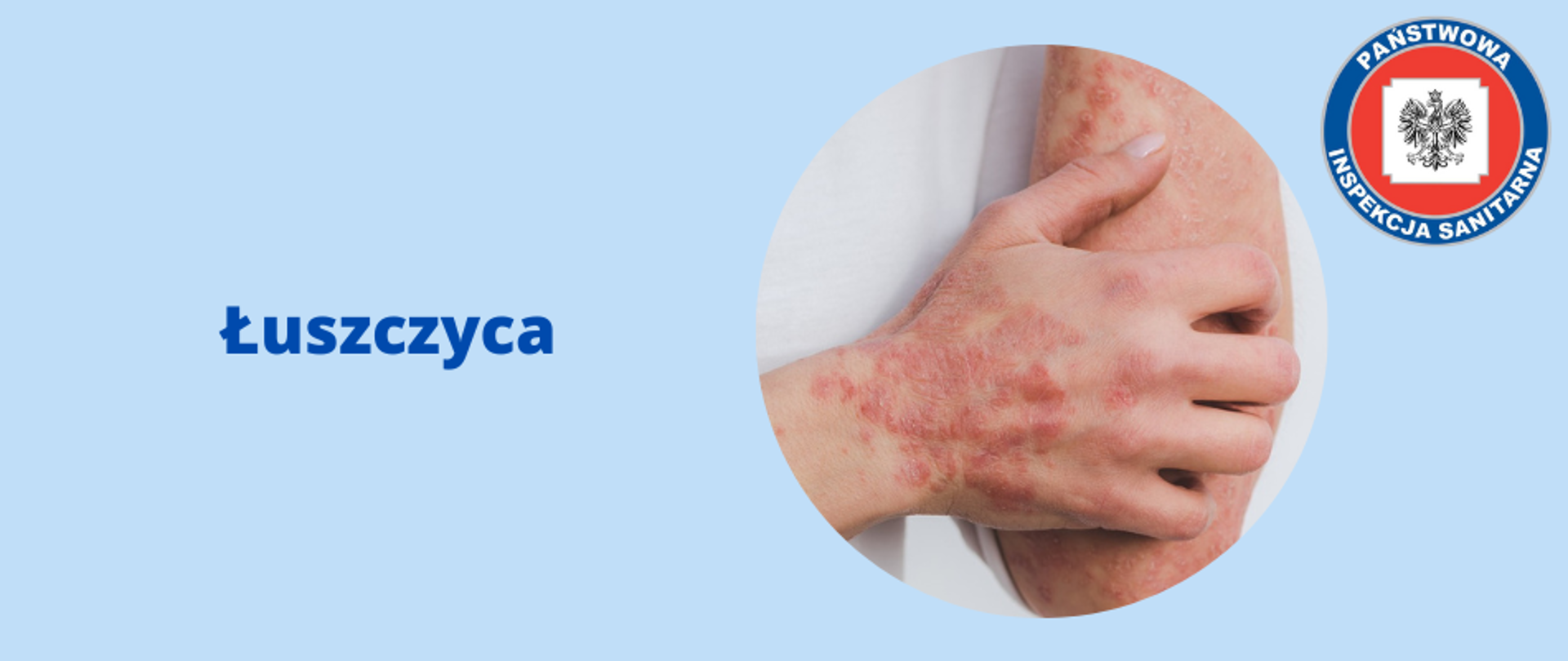 łuszczyca