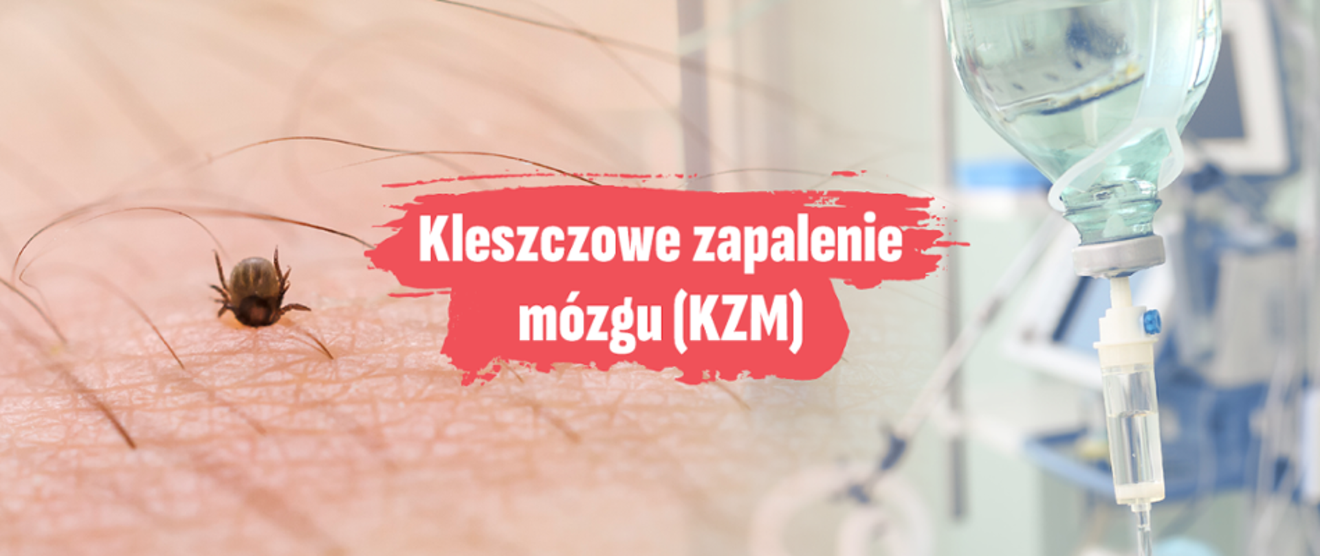 Zbliżenie na kleszcza wbitego w ludzką skórę