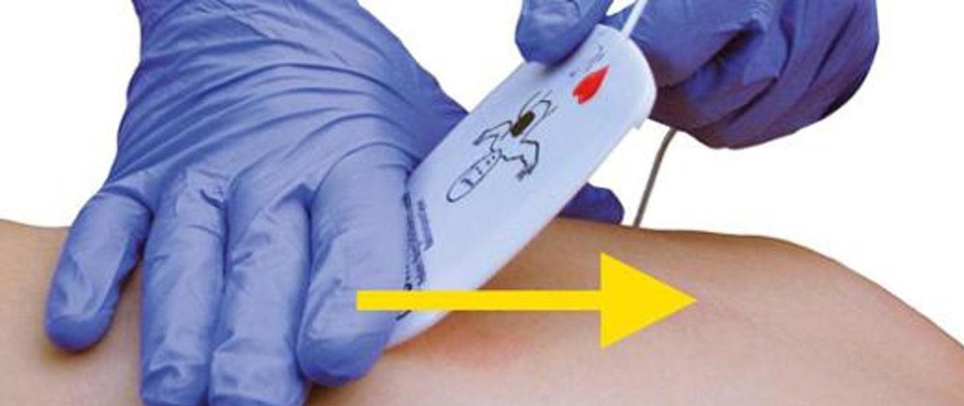 Obraz pokazuje przymocowanie elektrody defibrylatora na ciele człowieka