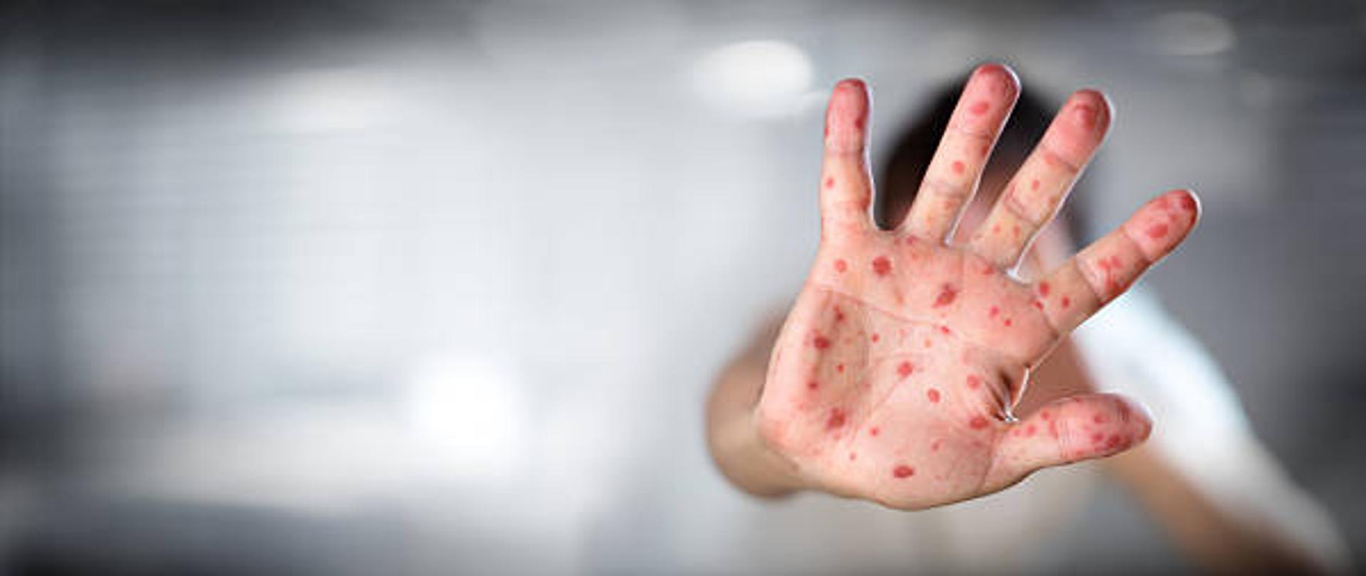 Viral Diseases - Hand Infected - Hand foot and mouth disease HFMD