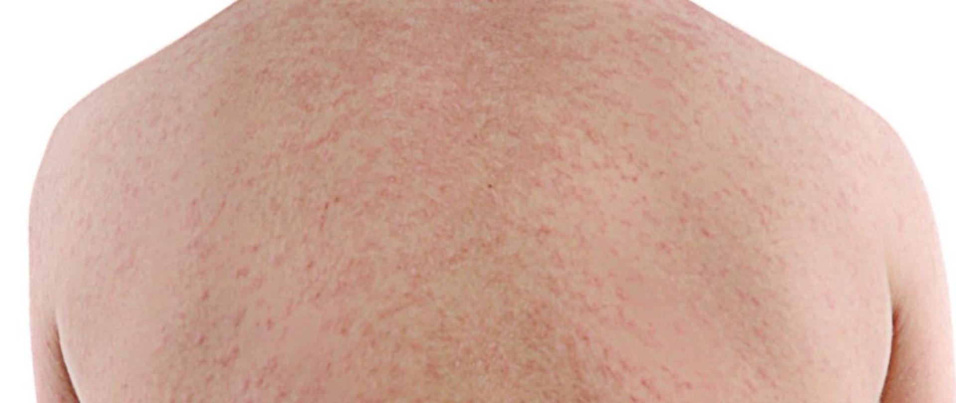 Widoczne plecy człowieka chorego na odrę