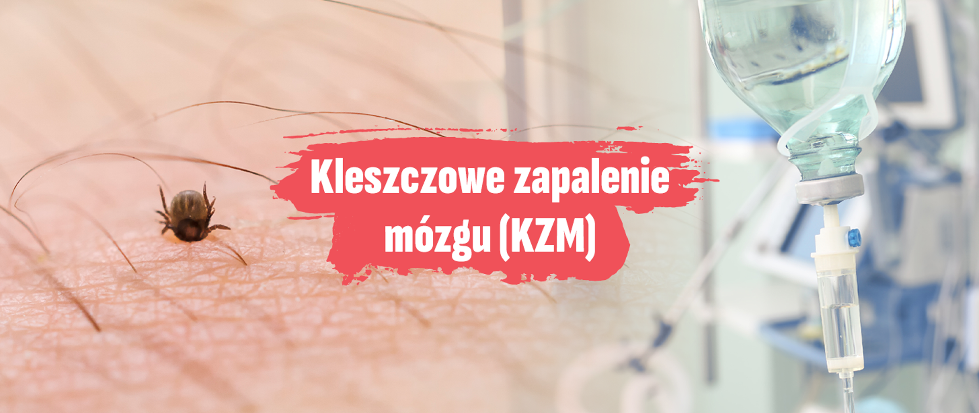 Kleszcze wbity w skórę, napis: Kleszczowe zapalenie mózgu, kroplówka