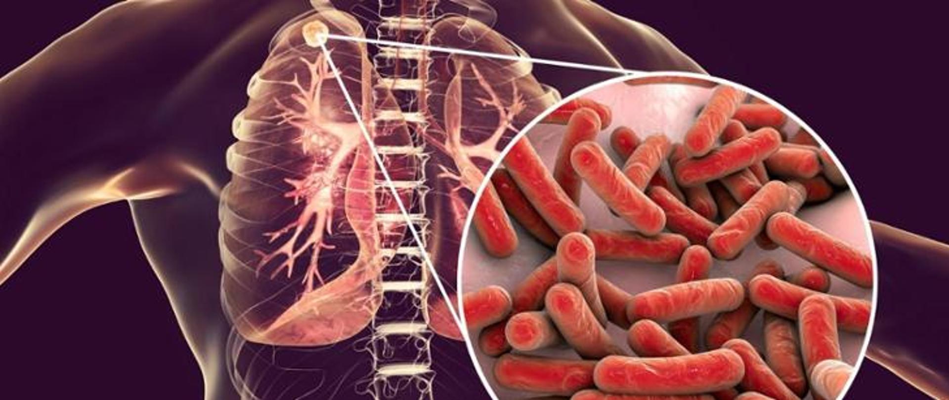 Co należy wiedzieć o gruźlicy