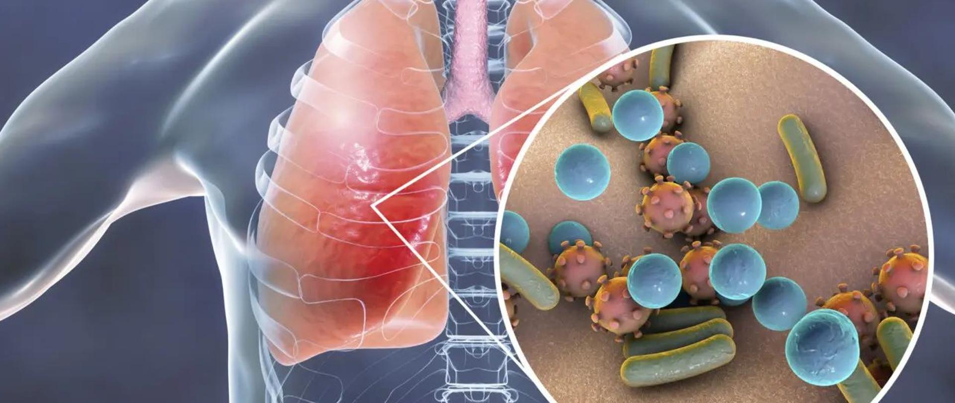 Zdjęcie przedstawiające ludzkie płuca i w powiększeniu bakterie.