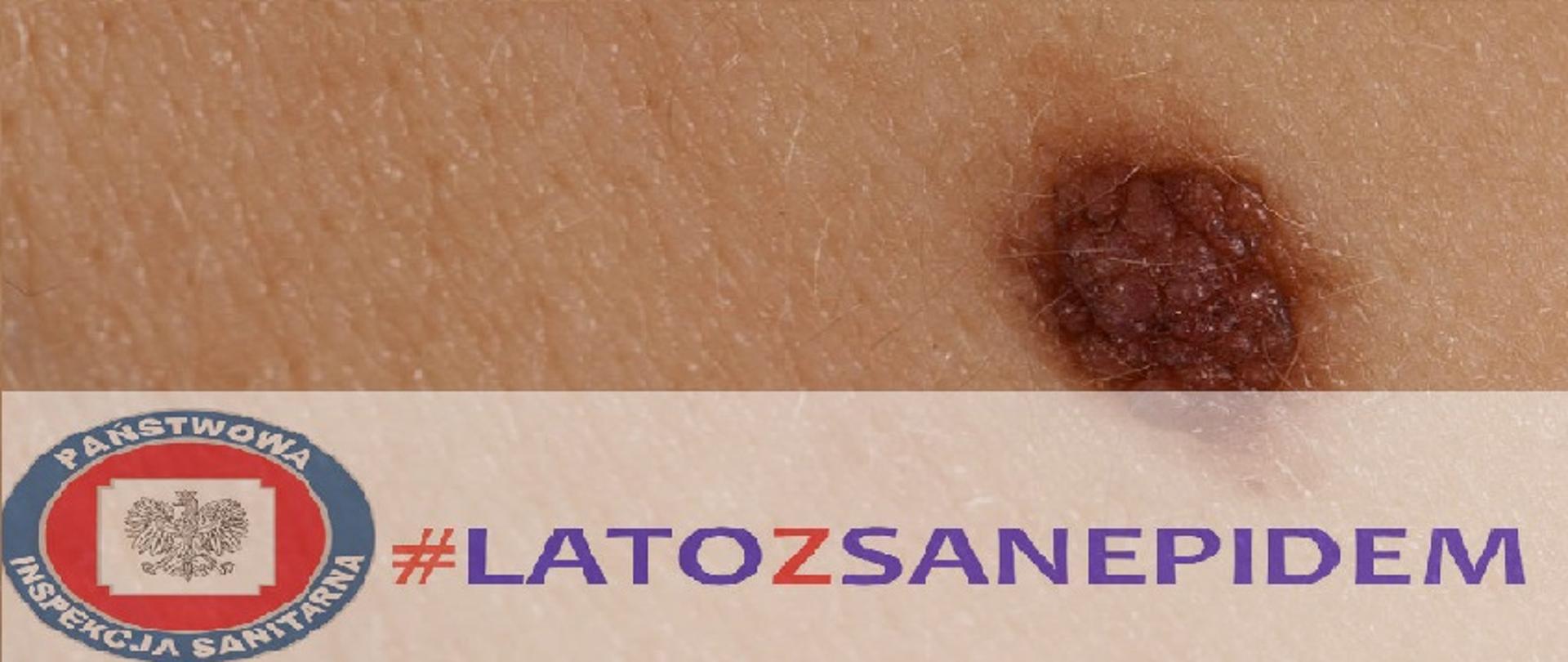 #latozsanepidem Co trzeba wiedzieć o czerniaku 