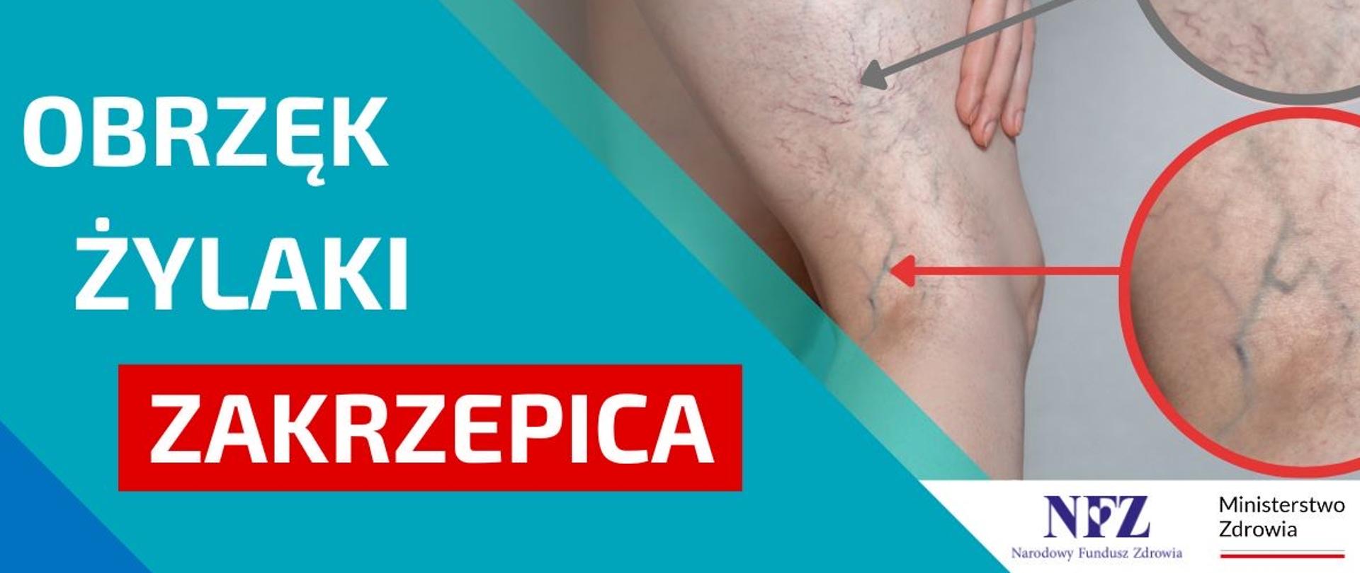 zakrzepica