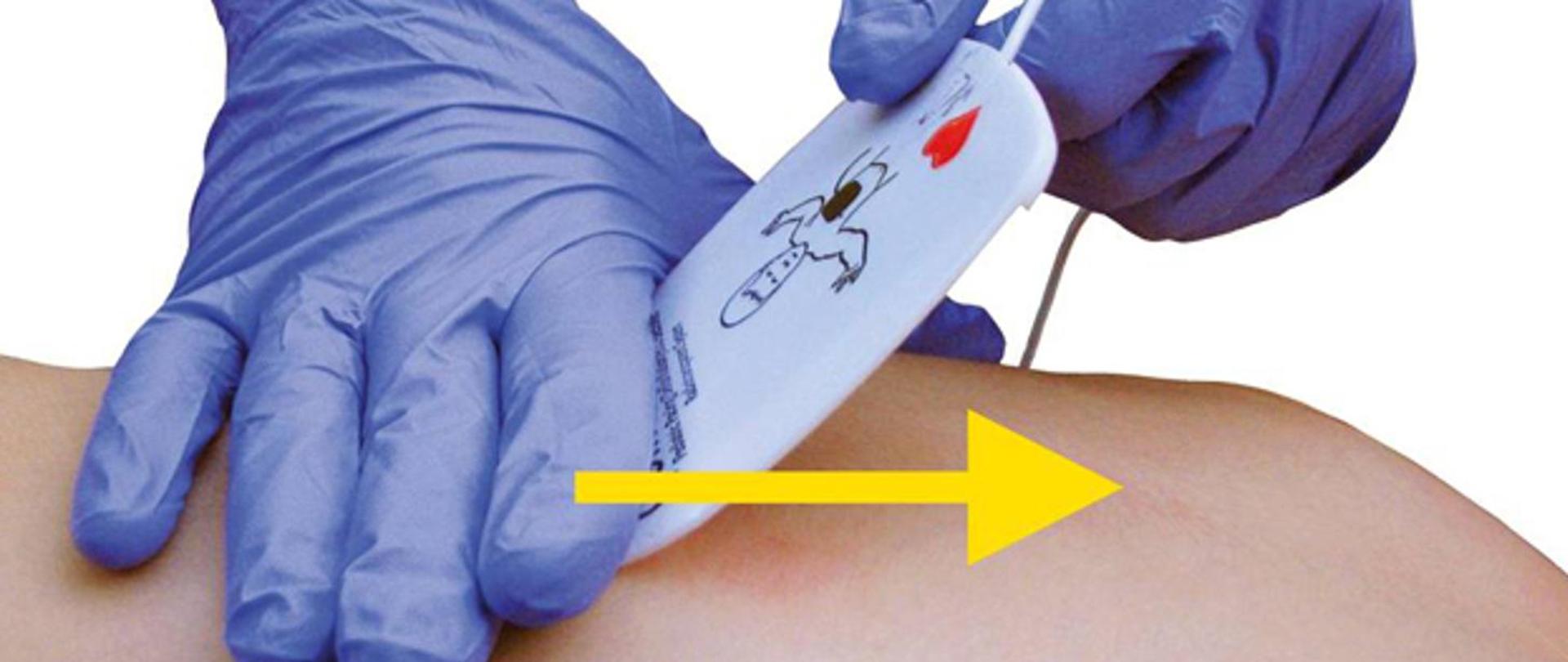 Zdjęcie przedstawia czynność przyklejania elektrody automatycznego defibrylatora zewnętrznego do klatki piersiowej osoby poszkodowanej. Czynność na zdjęciu wykonywana jest w rękawiczkach nitrylowych.