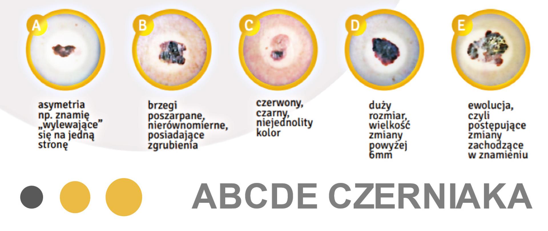 ABCDE-czerniaka