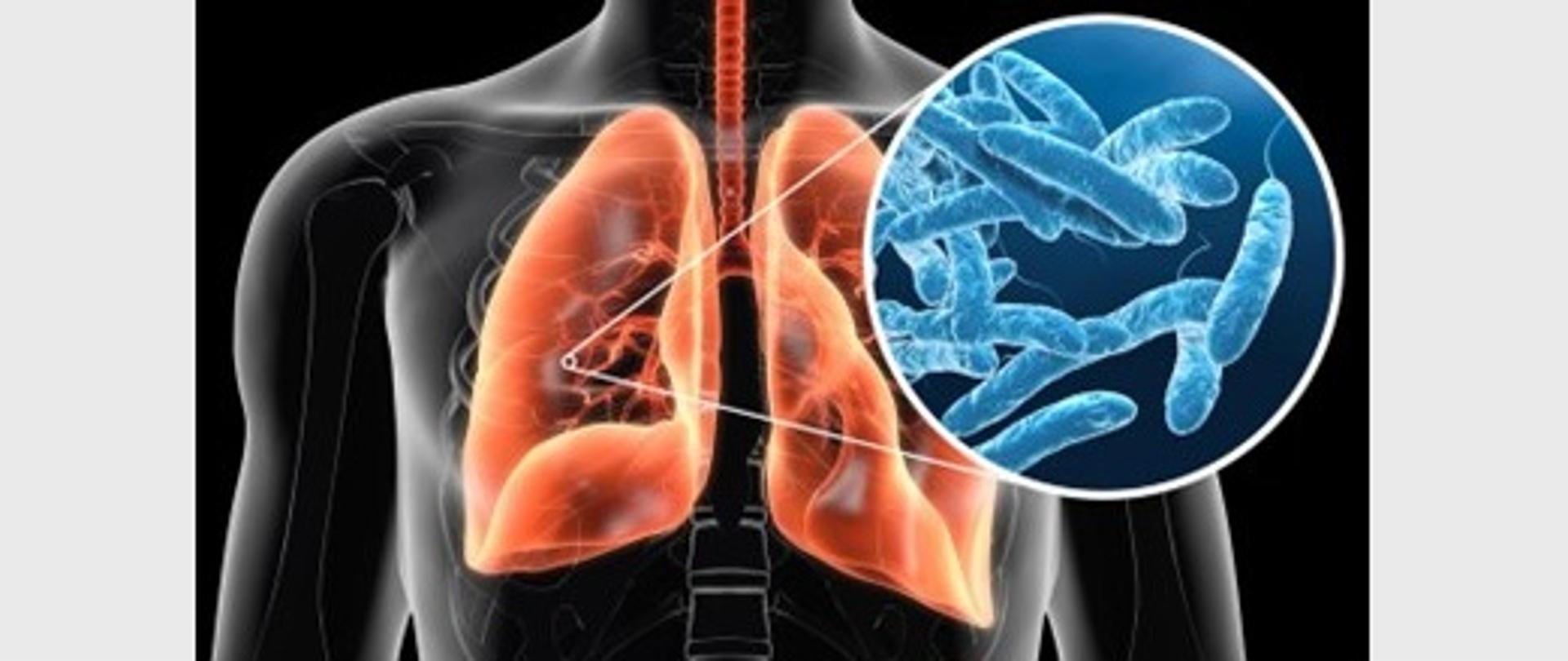 Obrazek przedstawia prześwietlenie klatki piersiowej człowieka , zaznaczono na pomarańczowo płuca , zaznaczono punkt na płucach po lewej stronie od niego prowadza dwie linie symbolizujace powiekszenie tego punktu na którym widać pałeczki bakterii