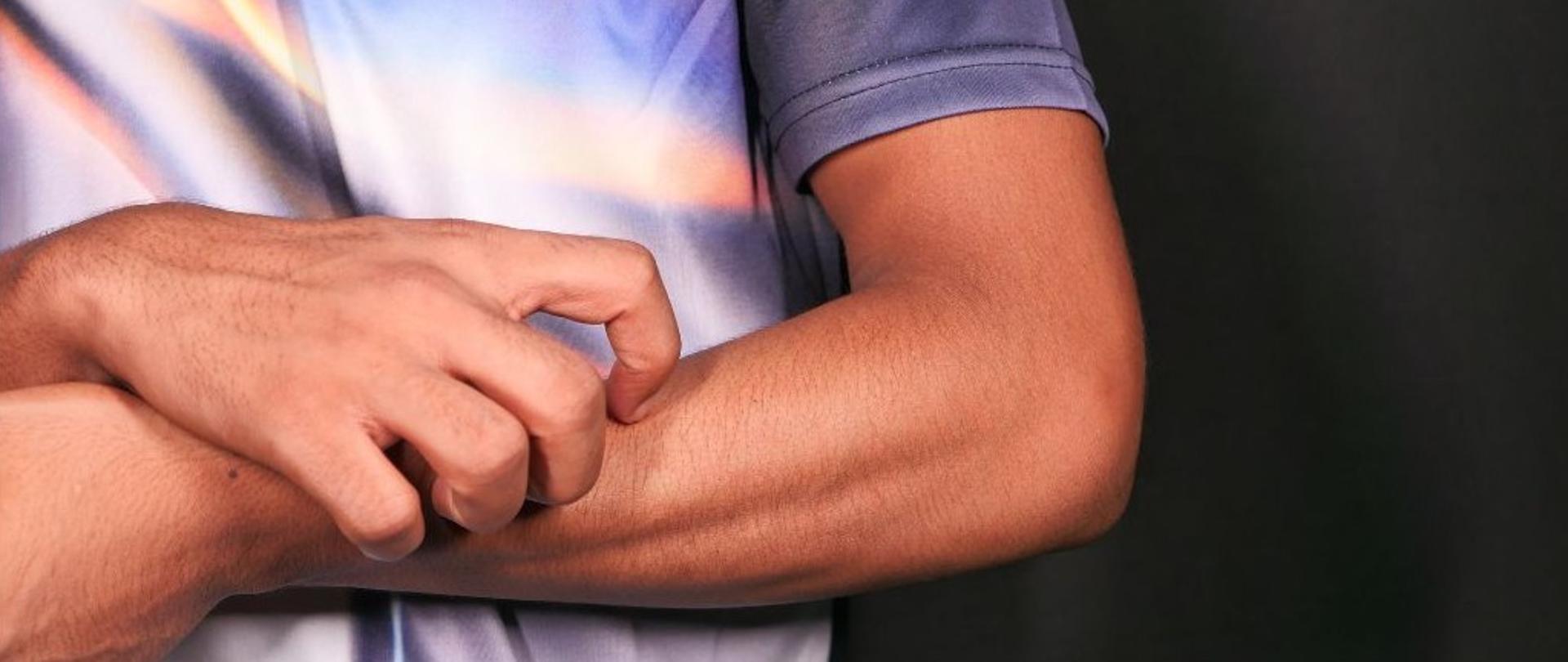 Informacje dotyczące świerzbu