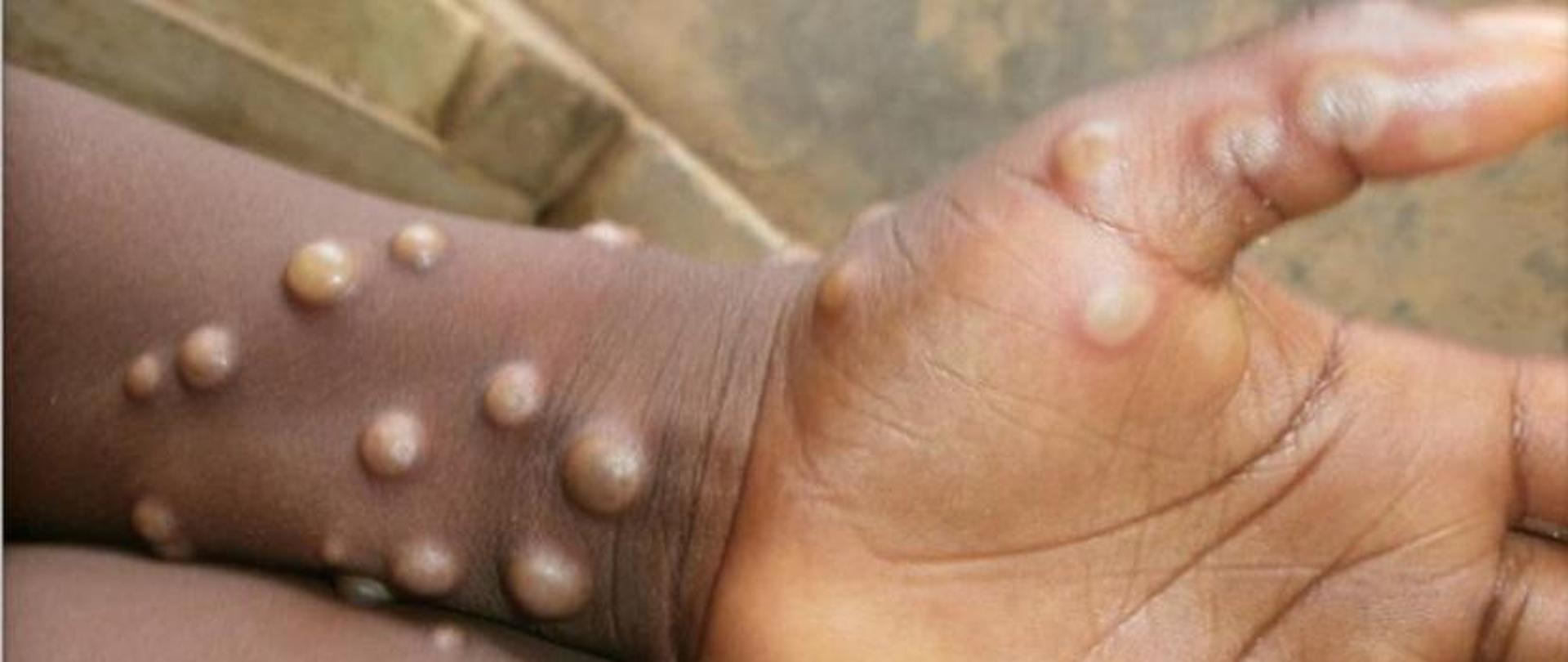 Zdjęcie przedstawiające dłoń osoby z objawami, tj wysypką małpiej ospy