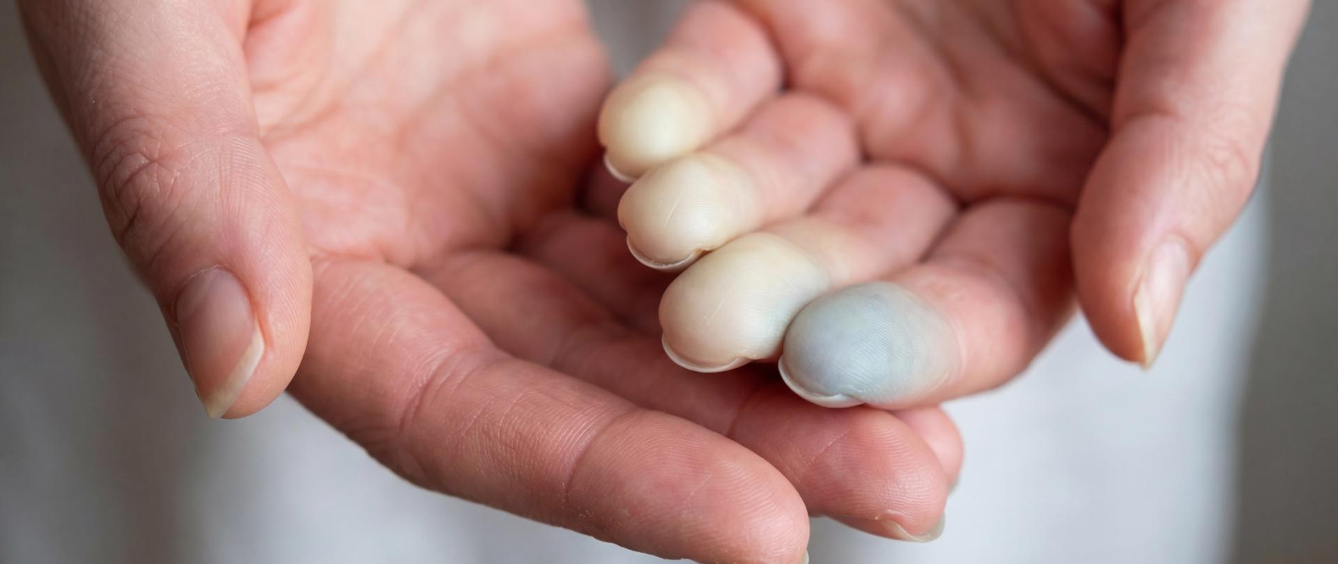 Na zdjęciu widać dwie dłonie, trzy palce jednej z nich są do połowy długości białe, a jeden biało-siny.