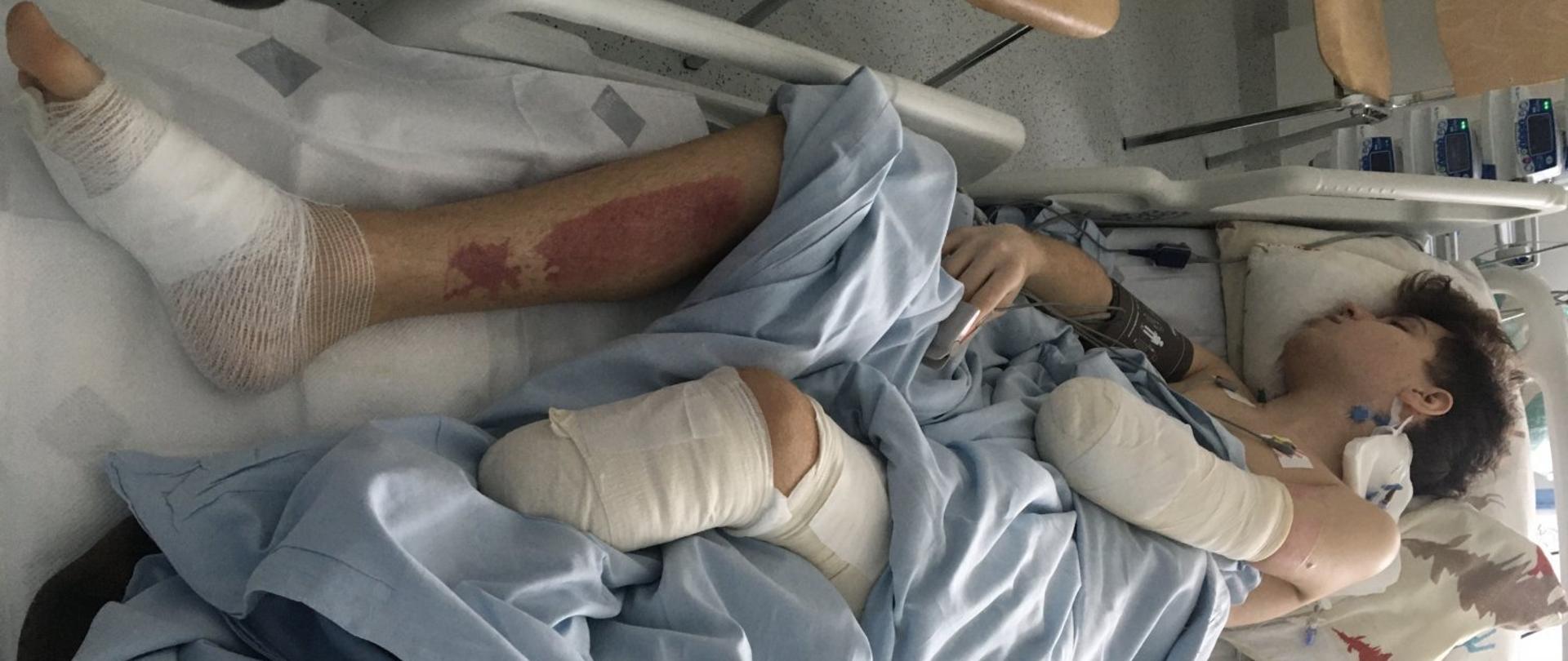 Zdjęcie przedstawia chłopca śpiącego na szpitalnym łóżku z amputowaną częścią lewej nogi i przedramienia oraz widocznymi poparzeniami na prawej nodze. 