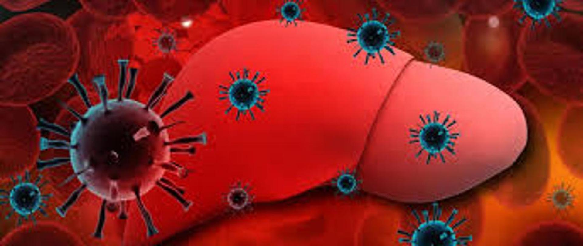 Wirusowe zapalenie wątroby typu A