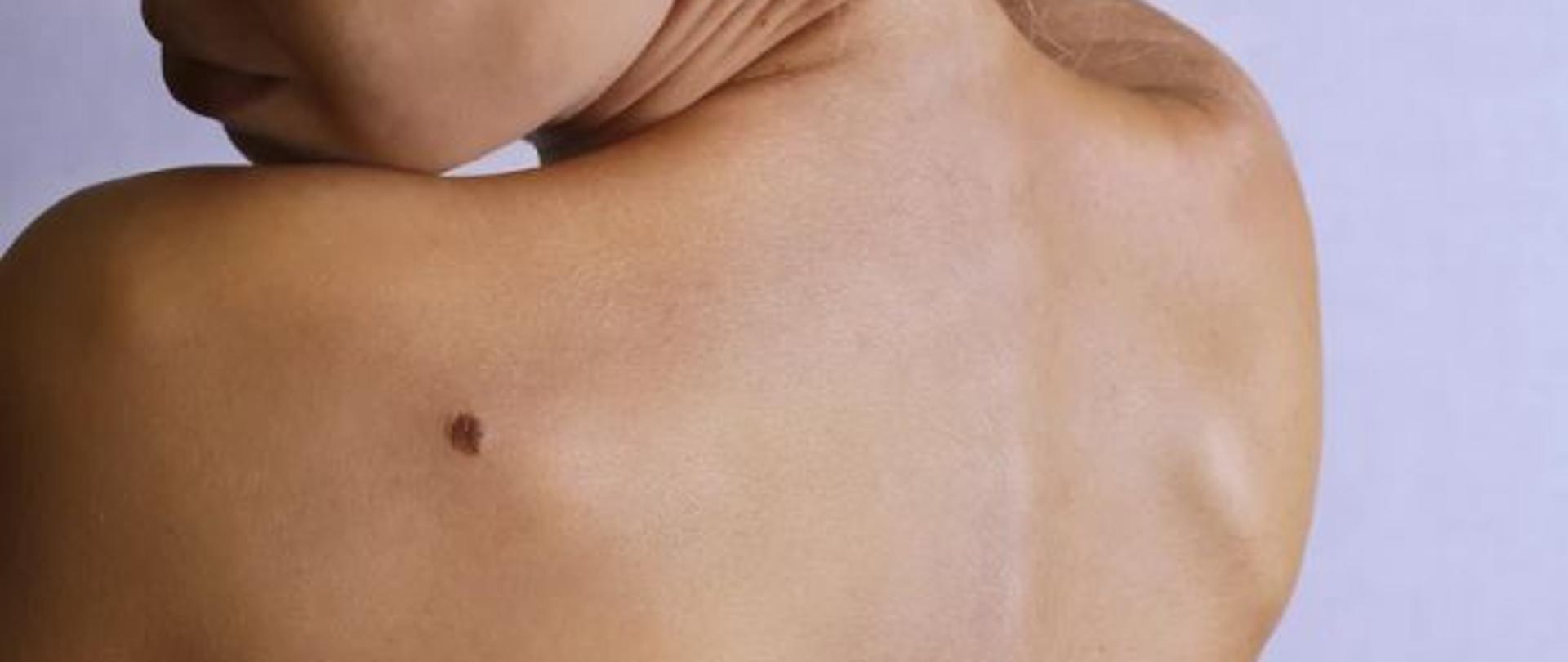 Zdjęcie przedstawia czerniaka na plecach kobiety