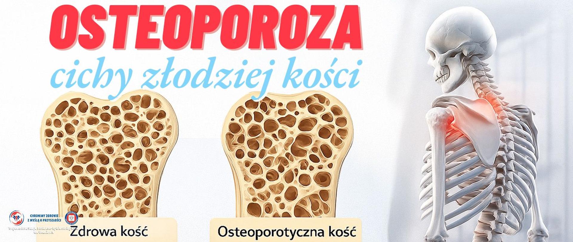 Porównanie kości zdrowej oraz kości osteoporotycznej, z prawej strony szkielet ludzki z zaznaczonymi na czerwono miejscami zmian osteoporotycznych
