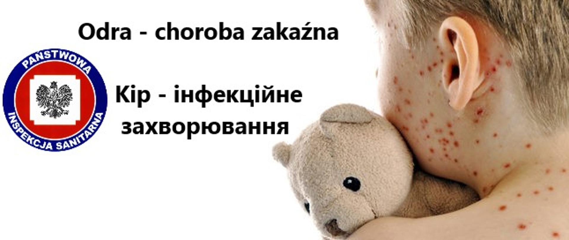 Odra - choroba zakaźna